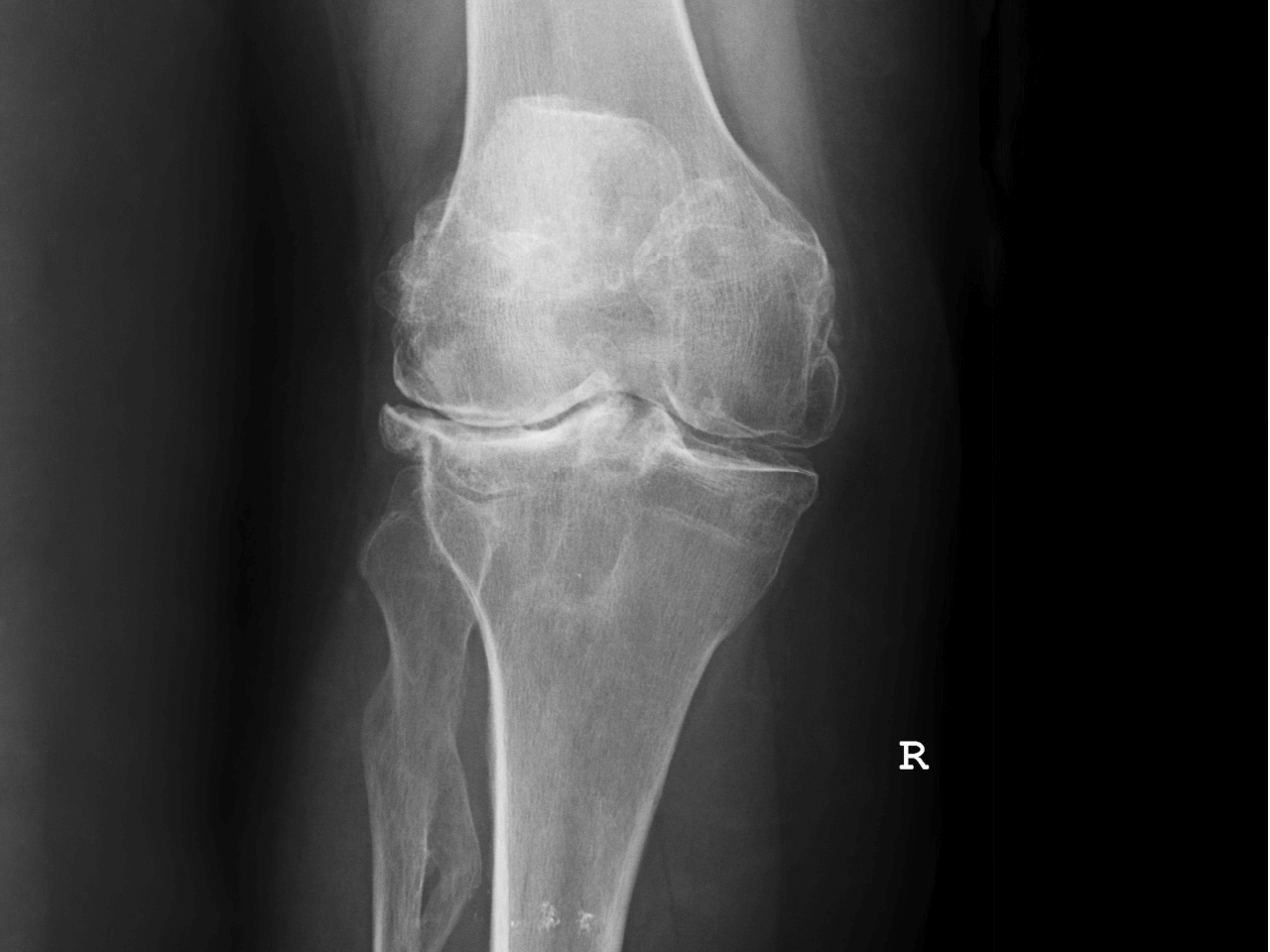 Arthrose FOURBS